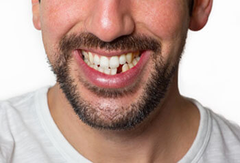 Dental Implants Sutton Coldfield