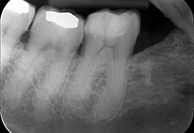 Patient 1 - Pre-treatment