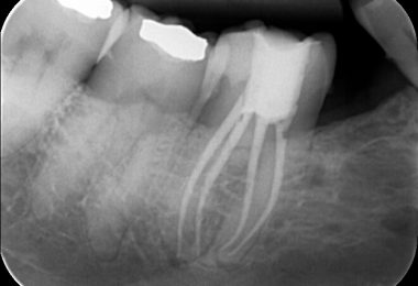 Patient 1 - Post-treatment