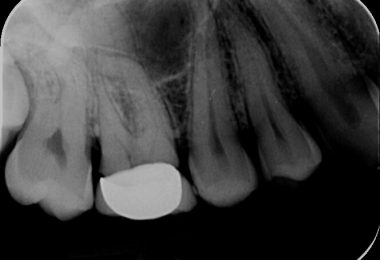 Patient 2 - Pre-treatment