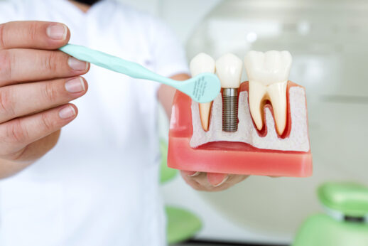What are dental implants?